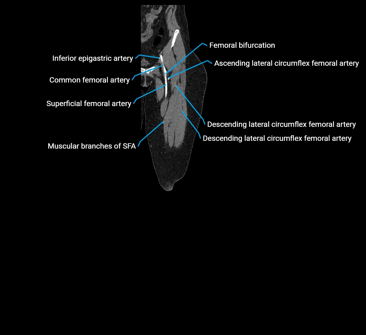 CTA lower limb coronal cross sectional anatomy labelled image _15 (2).webp